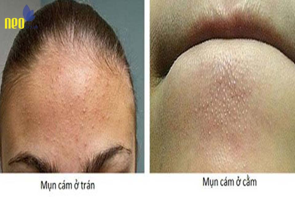 cach tri mun cam 3