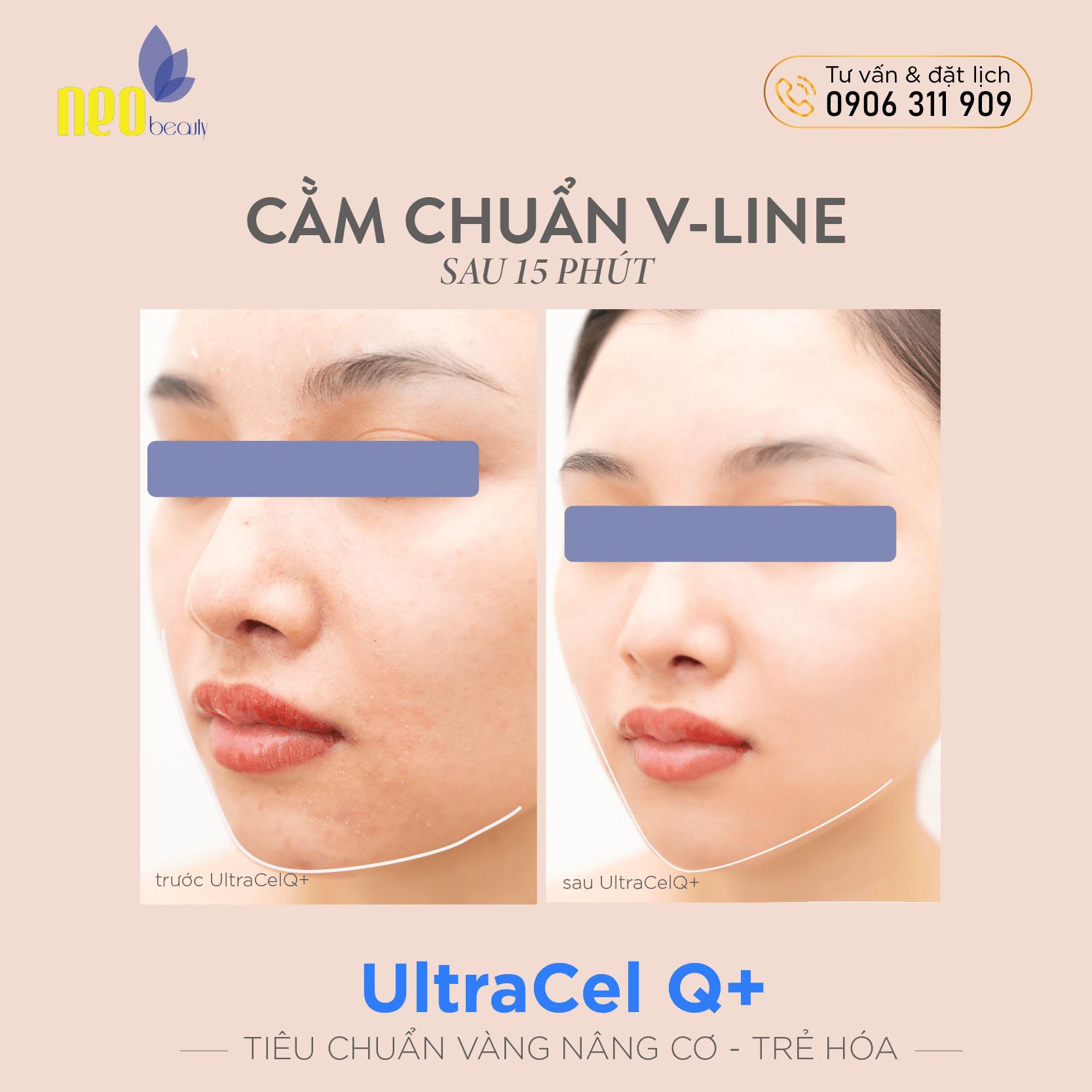 cong nghe lam dep ultracel 3
